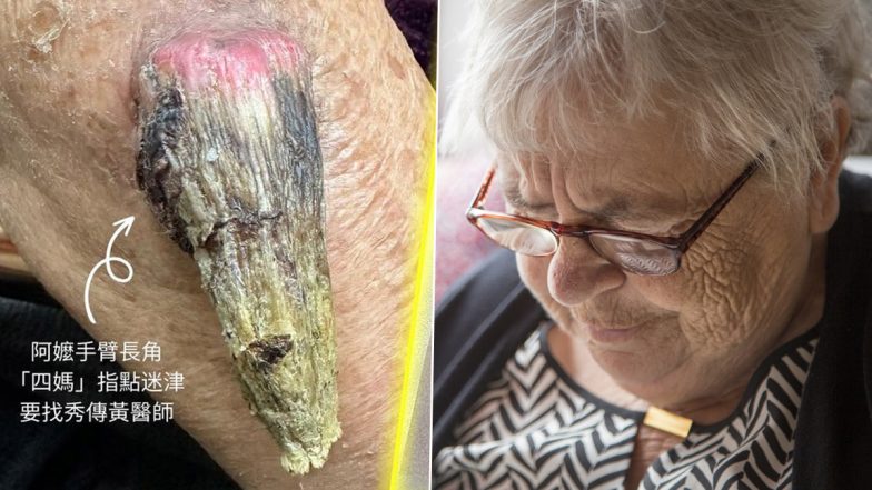 Strange! Rare ‘Fairy’ Horn Grows on Grandmother’s Arm in Taiwan; The Appendage Measures 7 Centimetres Long!