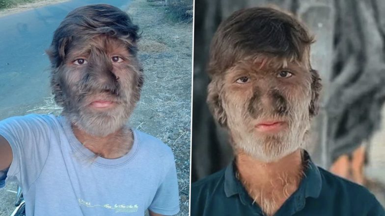 Werewolf Syndrome: MP Teen Lalit Patidar Suffering from The Rare Skin Condition Opens Up About Being Bullied For Excessive Hair Growth Anywhere on Body (See Pics)