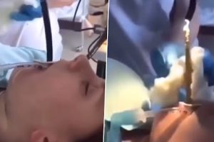 Snake in Woman’s Mouth: Doctors Remove Four-Feet-Long Serpent That Slithered Down Her Throat While Sleeping (Graphic Video Warning)