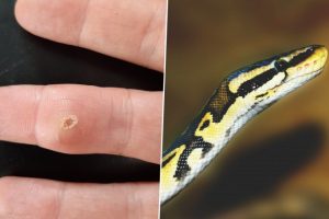 Snake Tooth Gets Lodged In Man's Swollen Finger; He Finds It Out After Years of 'Unmerciful Pain' (See Pics)