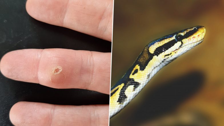 Snake Tooth Gets Lodged In Man’s Swollen Finger; He Finds It Out After Years of ‘Unmerciful Pain’ (See Pics)